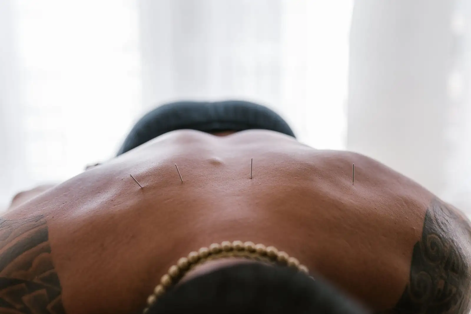 Acupuncture : à quoi ça sert et comment se déroule la séance